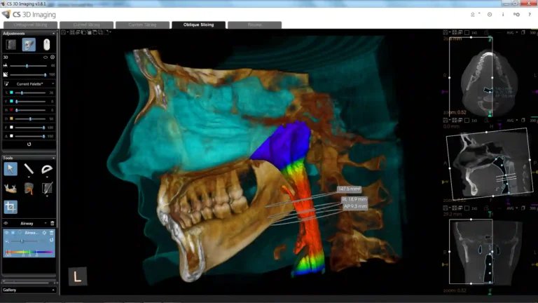 Carestream Dental EMR Software Demo displaying 3D imaging for dental anatomy with patient records, imaging tools, and treatment planning features.